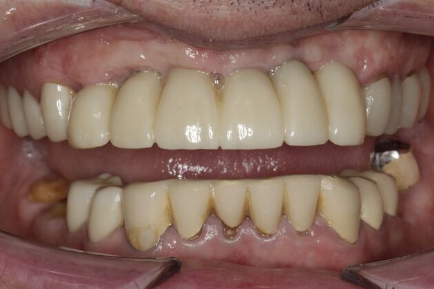 Full Mouth Rehabilitation Paul - Before