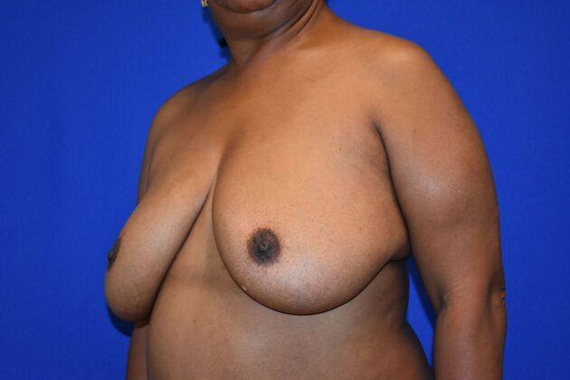 Breast Reconstruction: Case 1 - DIEP flaps after Oncoplastic reduction for Nipple Sparing result - Before