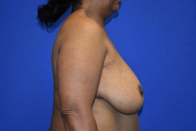 Breast Reconstruction: Case 1 - DIEP flaps after Oncoplastic reduction for Nipple Sparing result - Before