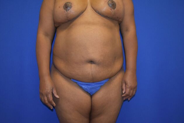 Breast Reconstruction: Case 1 - DIEP flaps after Oncoplastic reduction for Nipple Sparing result - Post Reduction