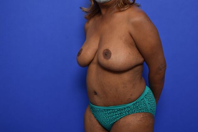 Breast Reconstruction: Case 1 - DIEP flaps after Oncoplastic reduction for Nipple Sparing result - After