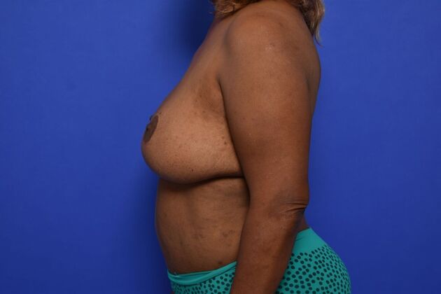 Breast Reconstruction: Case 1 - DIEP flaps after Oncoplastic reduction for Nipple Sparing result - After