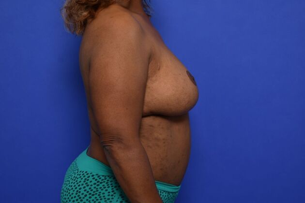 Breast Reconstruction: Case 1 - DIEP flaps after Oncoplastic reduction for Nipple Sparing result - After