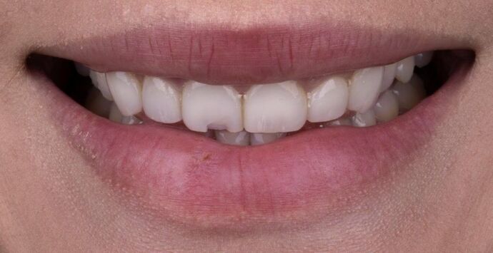 Smile Makeover & Veneers: Margaret - Before