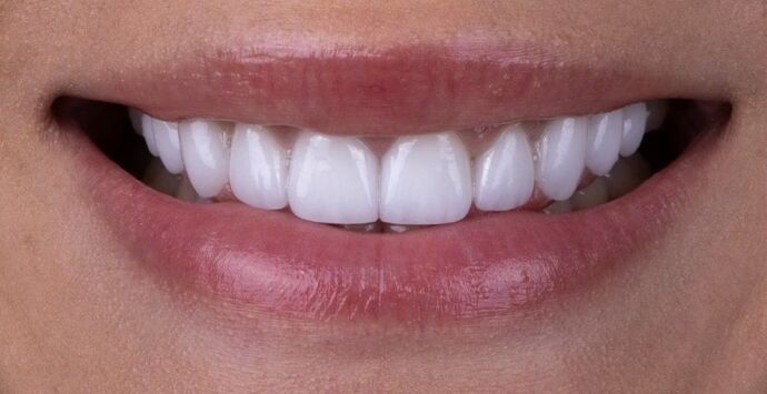Smile Makeover & Veneers: Margaret - After