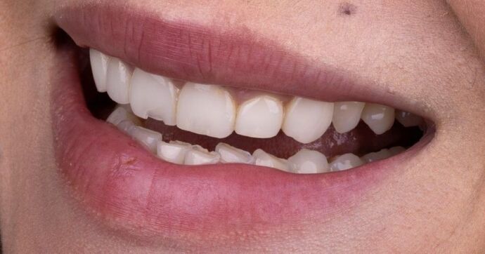 Smile Makeover & Veneers: Margaret - Before