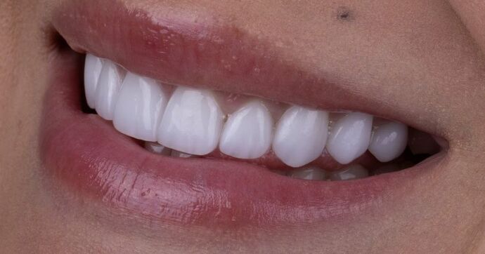 Smile Makeover & Veneers: Margaret - After