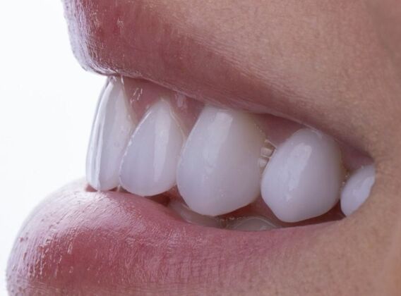 Smile Makeover & Veneers: Margaret - After