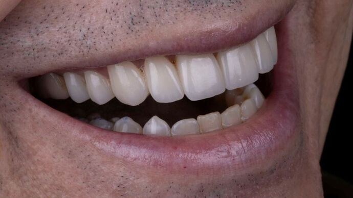 Smile Makeover & Veneers: Daniel - After