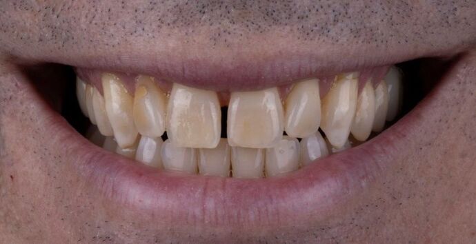 Smile Makeover & Veneers: Daniel - Before