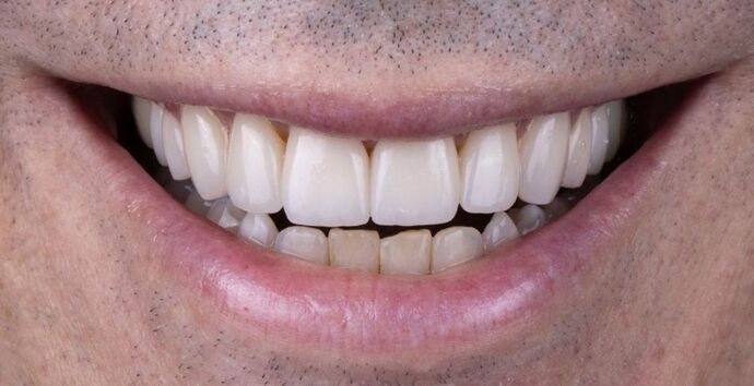 Smile Makeover & Veneers: Daniel - After