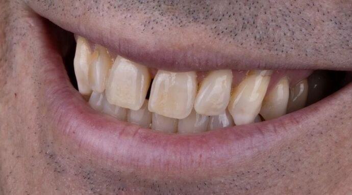 Smile Makeover & Veneers: Daniel - Before