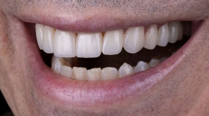 Smile Makeover & Veneers: Daniel - After