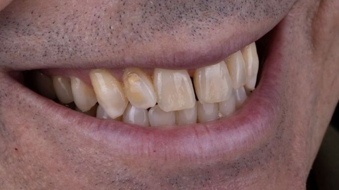 Smile Makeover & Veneers: Daniel - Before