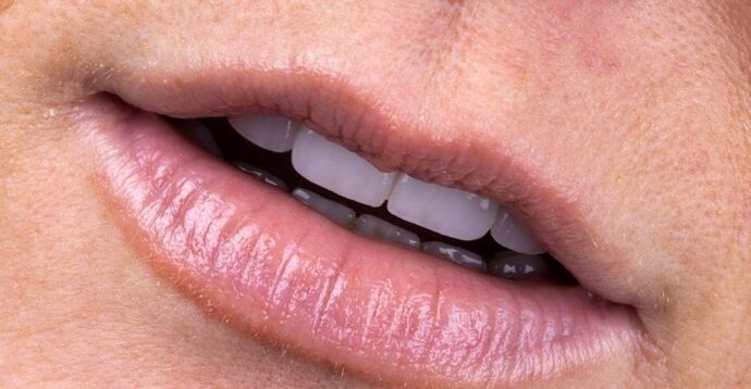 Smile Makeover & Veneers: Maren - After