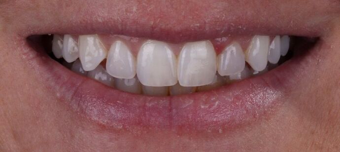 Smile Makeover & Veneers: Maren - Before