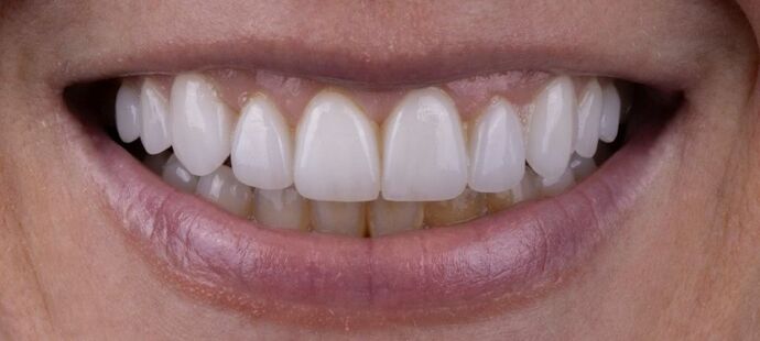 Smile Makeover & Veneers: Maren - After
