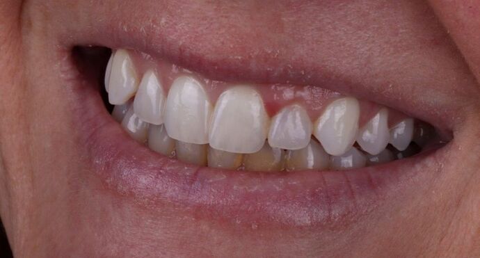 Smile Makeover & Veneers: Maren - Before