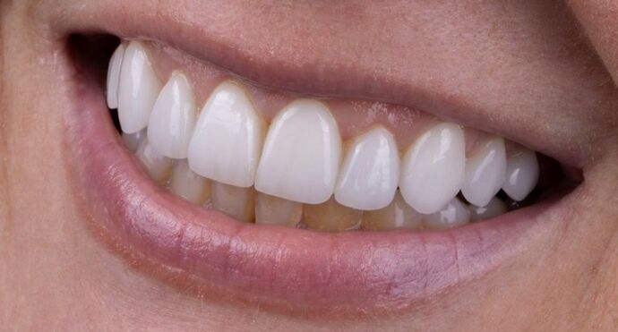 Smile Makeover & Veneers: Maren - After