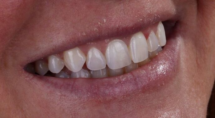 Smile Makeover & Veneers: Maren - Before