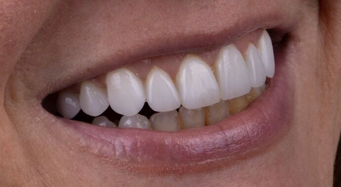 Smile Makeover & Veneers: Maren - After
