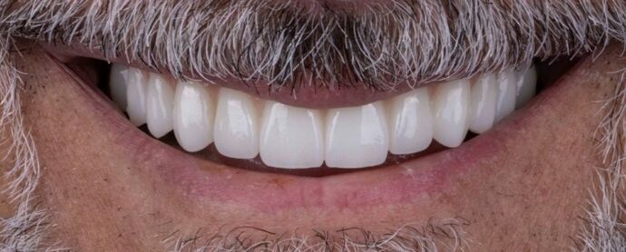 Smile Makeover & Veneers: Callum - After