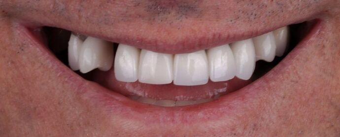 Smile Makeover & Veneers: Callum - Before