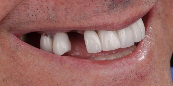 Smile Makeover & Veneers: Callum - Before