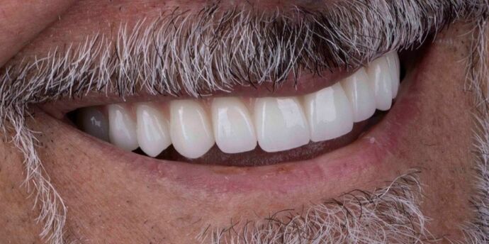Smile Makeover & Veneers: Callum - After