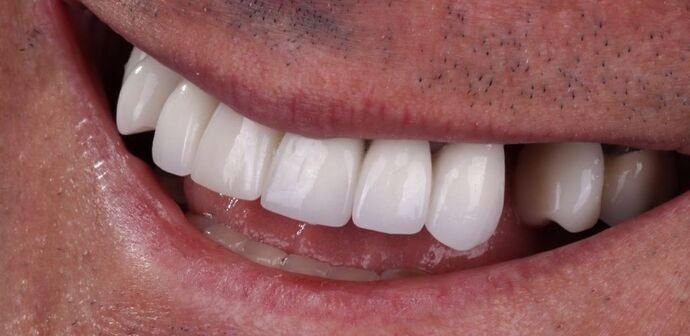 Smile Makeover & Veneers: Callum - Before