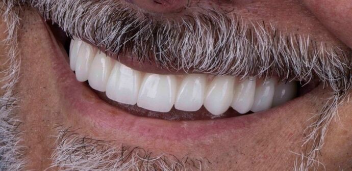 Smile Makeover & Veneers: Callum - After