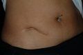 Scar Revision