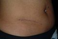 Scar Revision