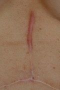 Scar Revision