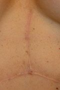 Scar Revision