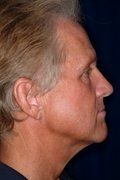 Facelift