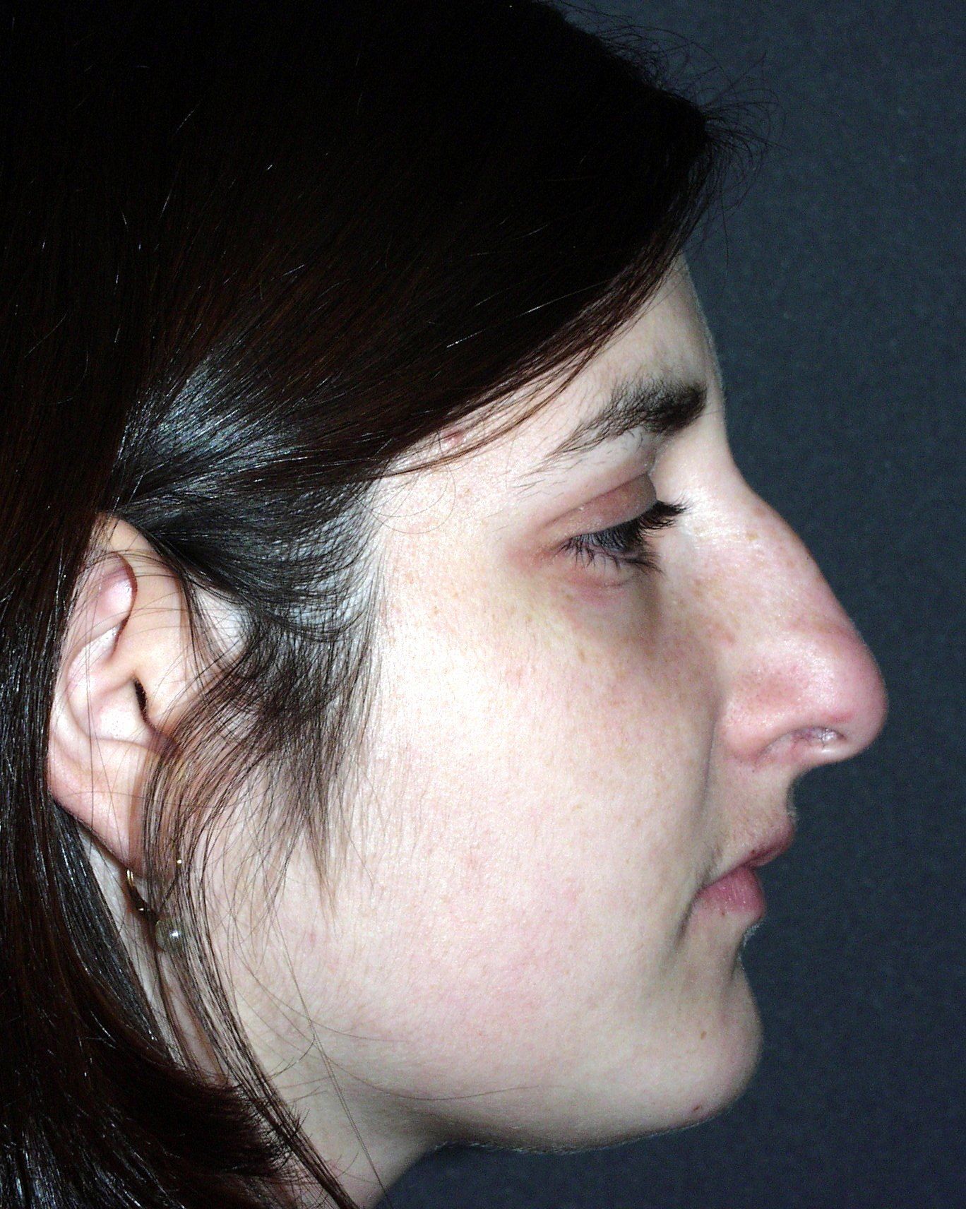Case 3 Rhinoplasty Before and After Gallery