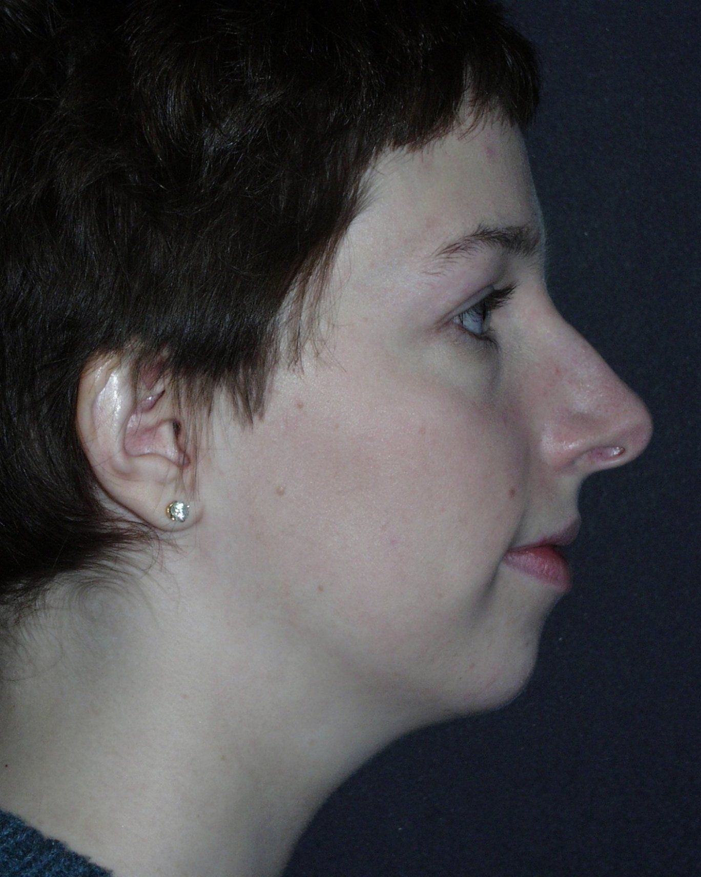 Case 5 Rhinoplasty Before and After Gallery