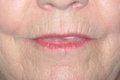 Lip Augmentation