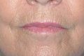 Lip Augmentation