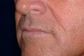 Lip Augmentation