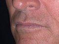 Lip Augmentation
