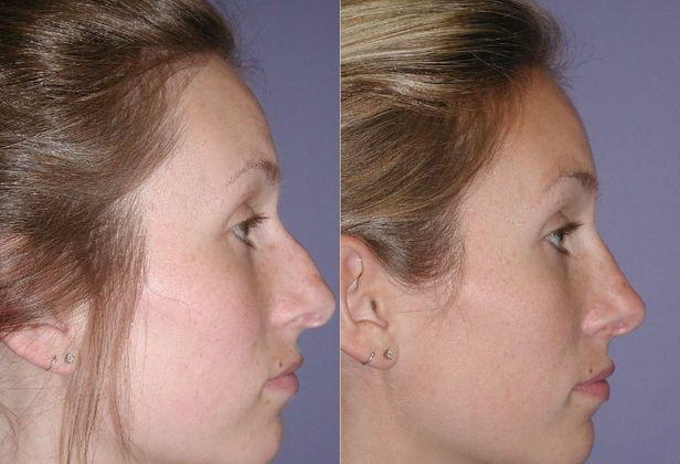 Rhinoplasty: Case 3