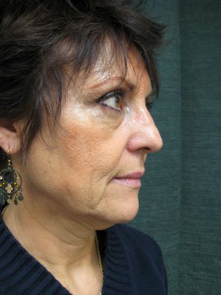 QuickLift: Case 1 - Oblique Preop