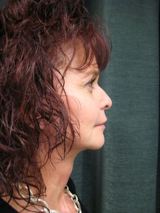 QuickLift: Case 3 - Lateral Postop