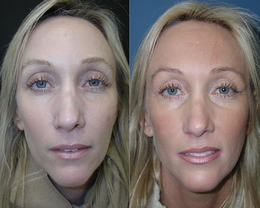 Blepharoplasty: Case 4