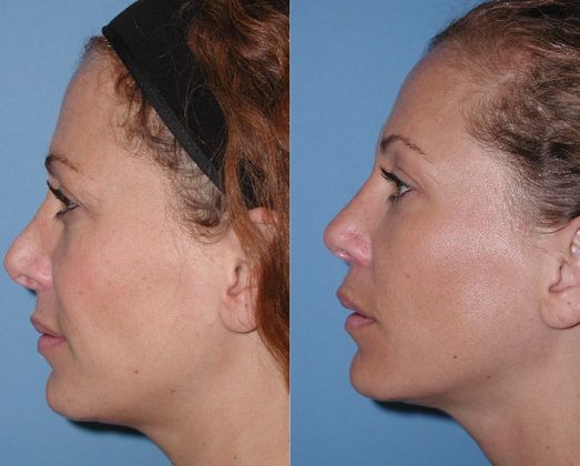 Revision Rhinoplasty