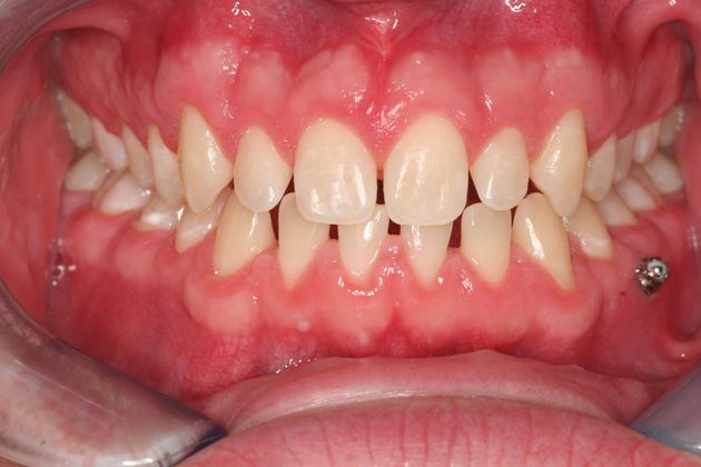Porcelain Veneers: Case 39: Bucks County - Before