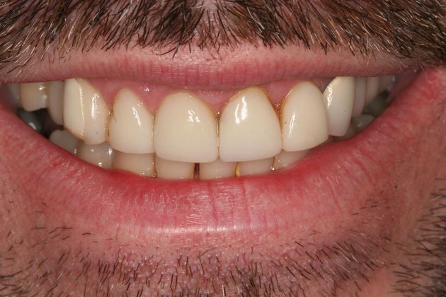 Porcelain Veneers Case 16: Bucks County PA - Before