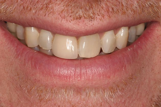 Porcelain Veneers: Case 19: Bucks County - Before